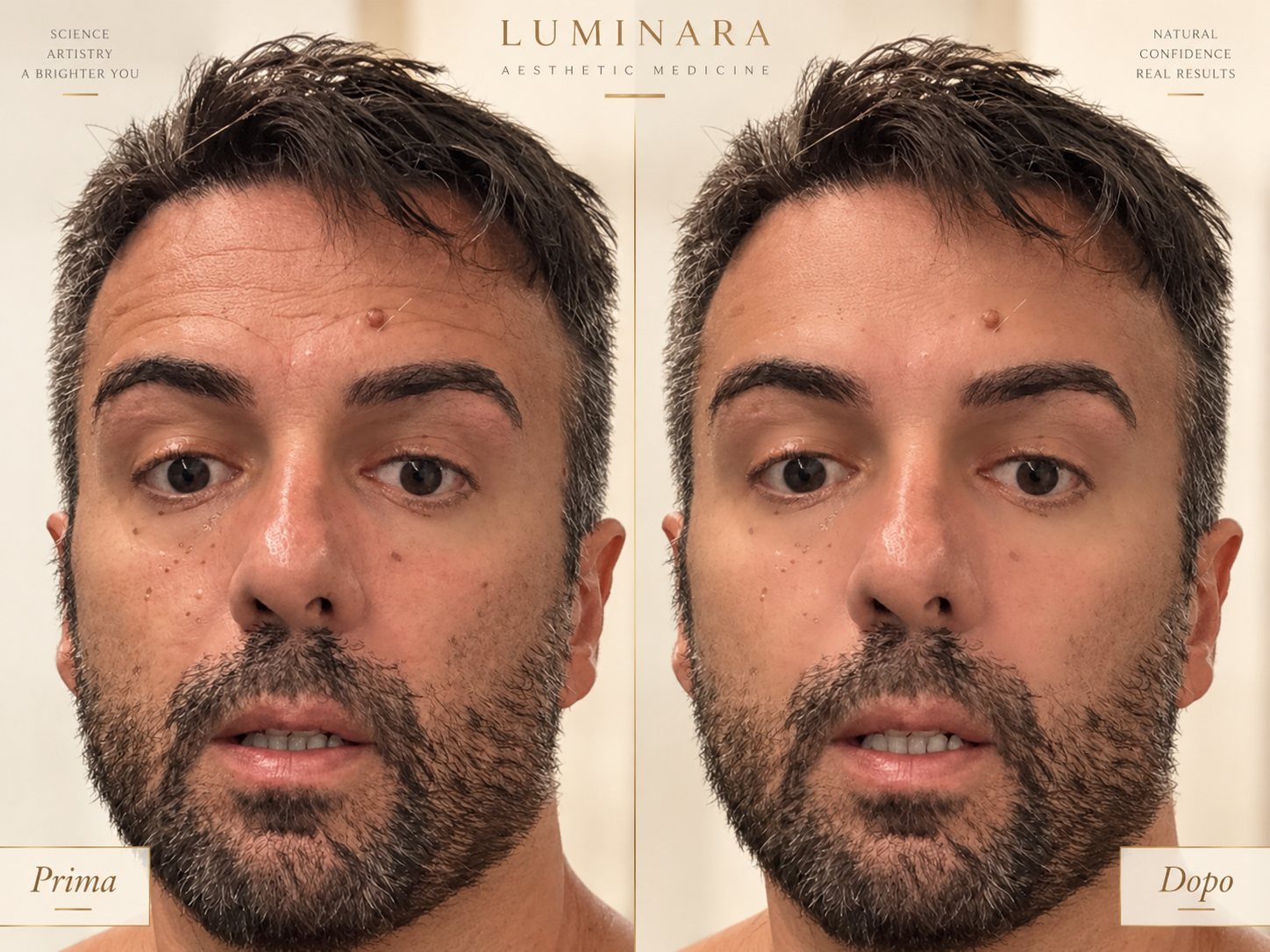 Secondo esempio Luminara prima e dopo trattamento estetico
